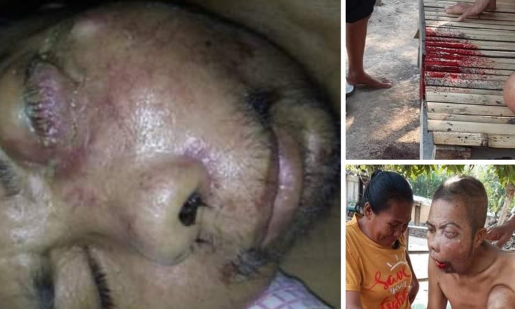 Bupati Siap Bantu Pengobatan Warganya Yang Derita Tumor Di desa Boro Kec Sanggar